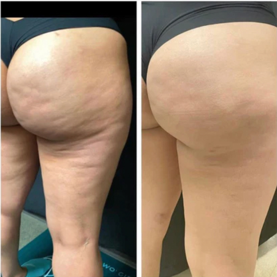 Avant / Après PerfectCurve